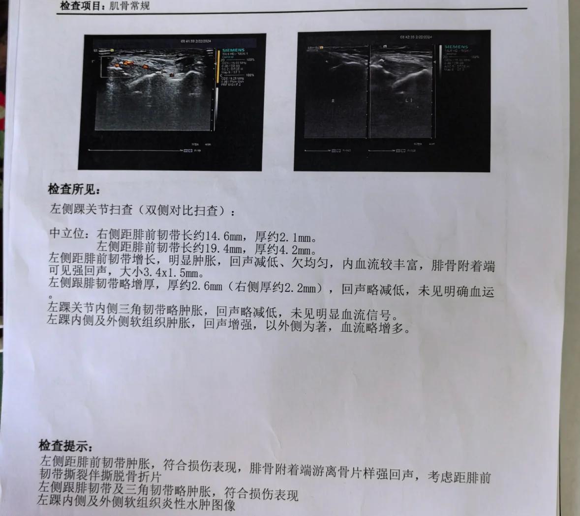 穆西亚拉腓骨骨折+韧带受伤预计伤缺4-5个月